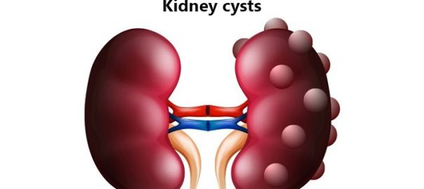 kidney cyst