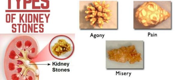 Kidney-Stone-Types