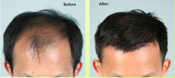 Hair Transplant