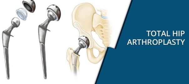 total hip arthroplasty
