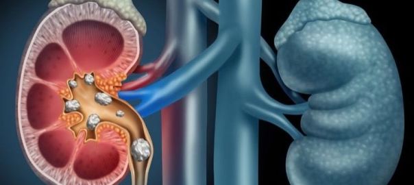 Kidney Stones