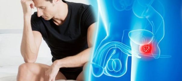 Prostate-Cancer-Impotence
