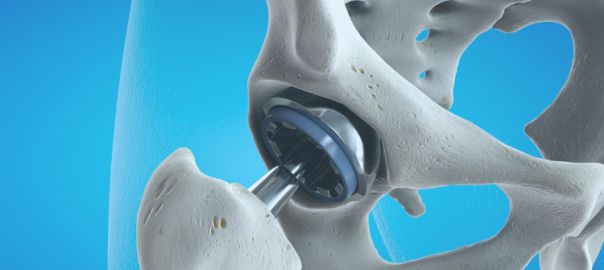 Hip Replacement