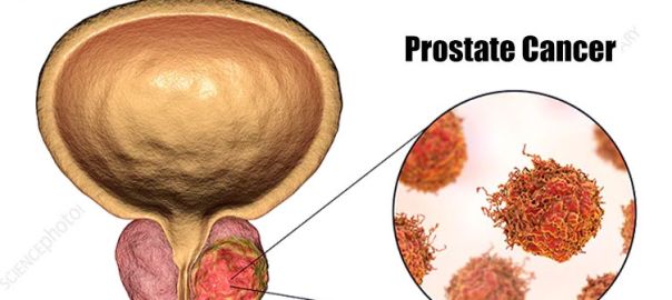 Prostate Cancer