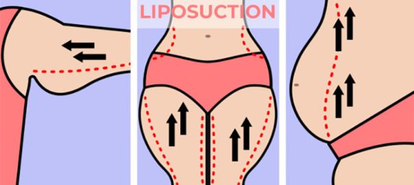 liposuction in Delhi