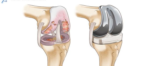 Total Knee Replacement