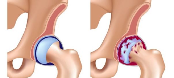Coxarthrosis - Hip Arthrosis