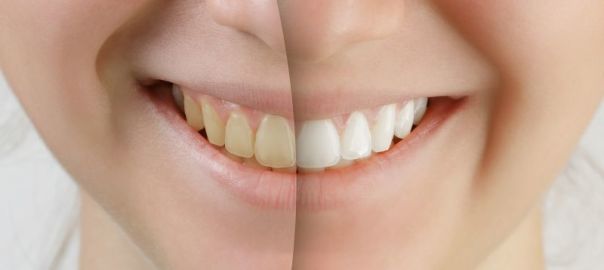 Teeth Whitening