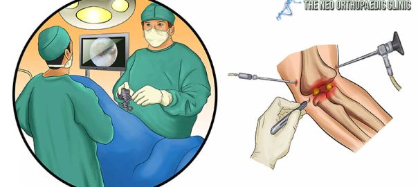 arthroscopy in Delhi