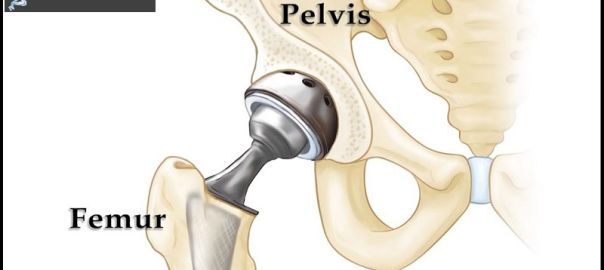 Hip Replacement Surgery