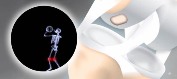 CARTILAGE DAMAGE
