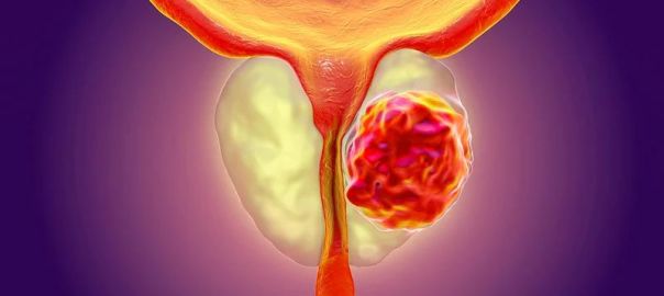 Prostate Cancer