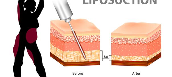 Liposuction in Delhi
