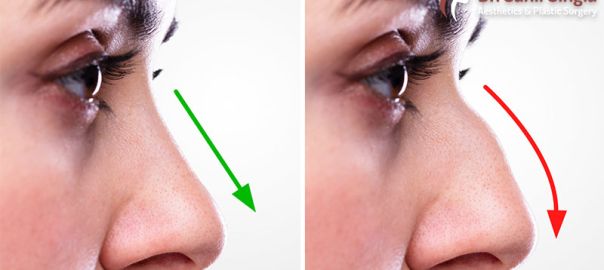 Rhinoplasty in Delhi