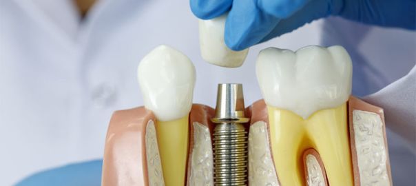 Dental Implant