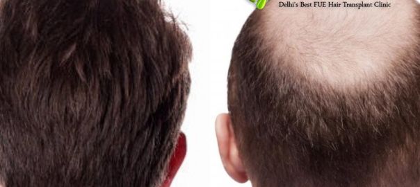 hair transplant
