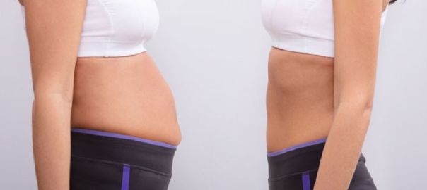 abdominoplasty