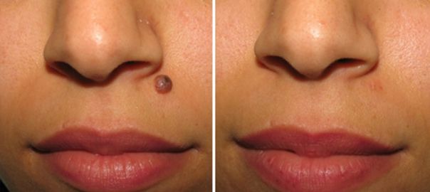 mole removal