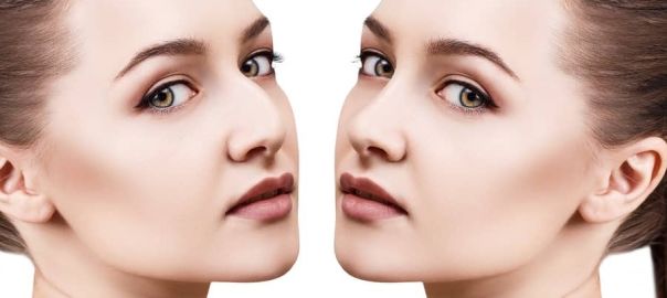 wide nose rhinoplasty