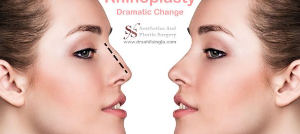 Rhinoplasty in Delhi