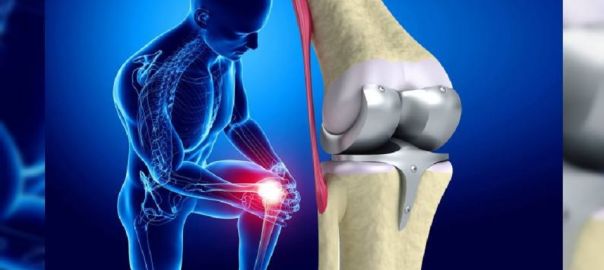 knee replacement surgery