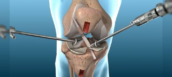 knee arthroscopy for knee injuries