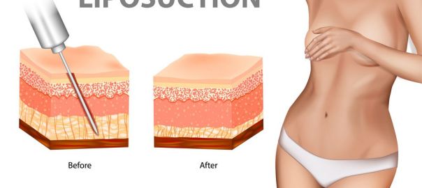 Liposuction in Delhi