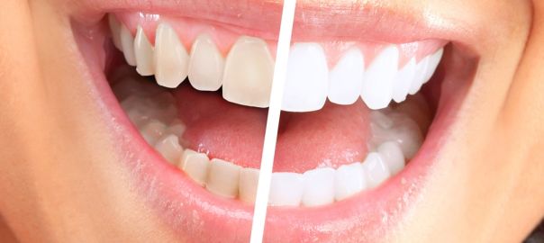 Teeth Whitening