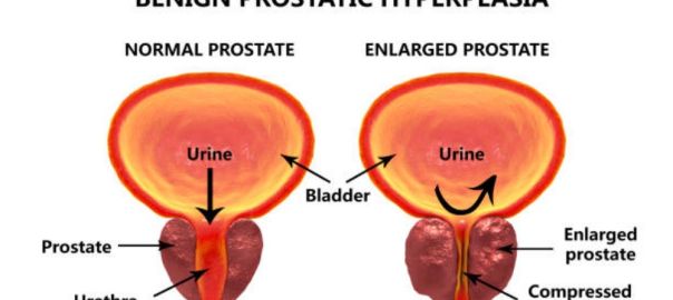 Benign Prostatic Hyperplasia
