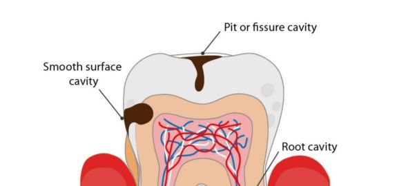 Types of dental caries