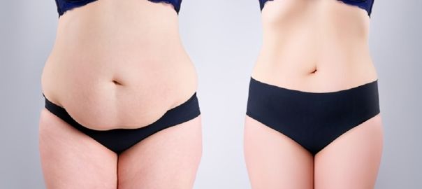 Abdominoplasty