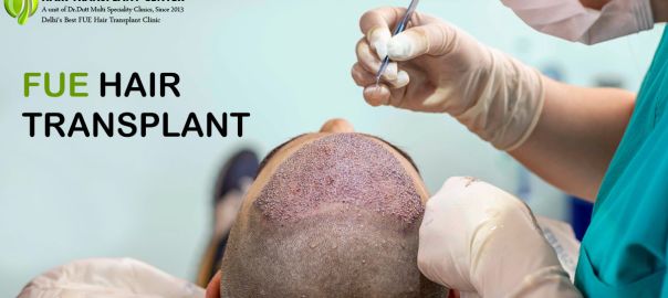 Hair Transplant in Delhi