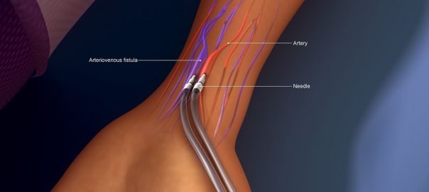 av fistula