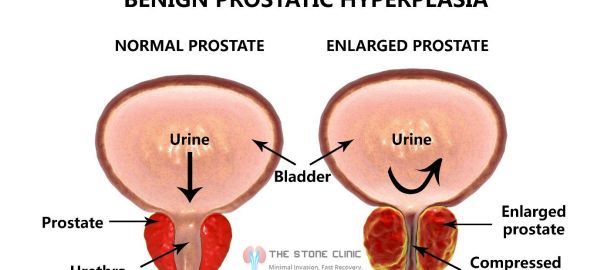 Prostate treatment in Pitampura