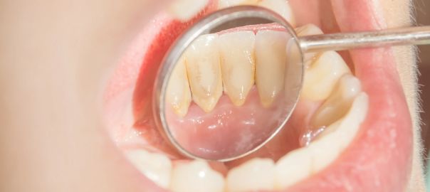 dental tartar