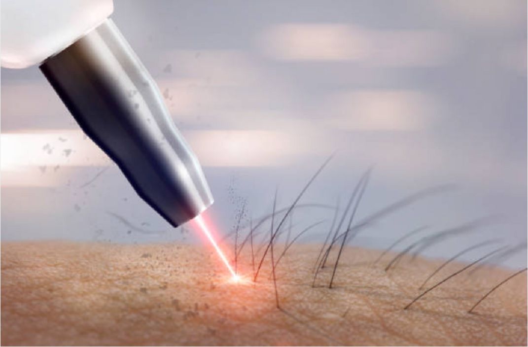 Laser Hair Removal: Truths and Myths Laser Hair Removal: Truths and Myths