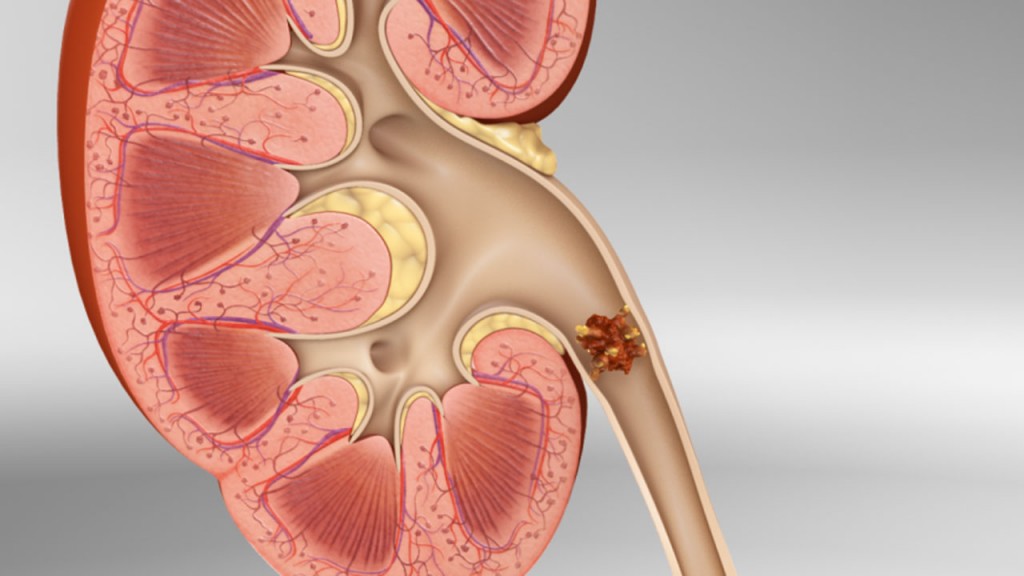 Kidney Stones: Causes, Symptoms and Treatments Kidney Stones: Causes, Symptoms and Treatments