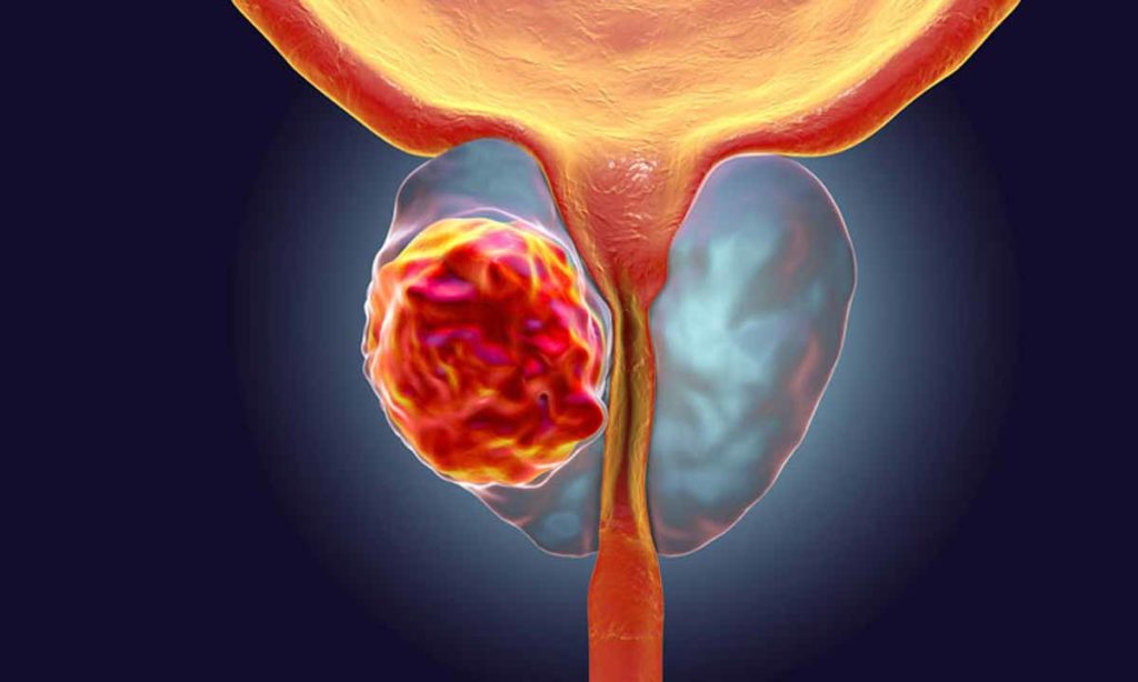 What is Prostate Cancer And It’s Treatment Options What is Prostate Cancer And It’s Treatment Options