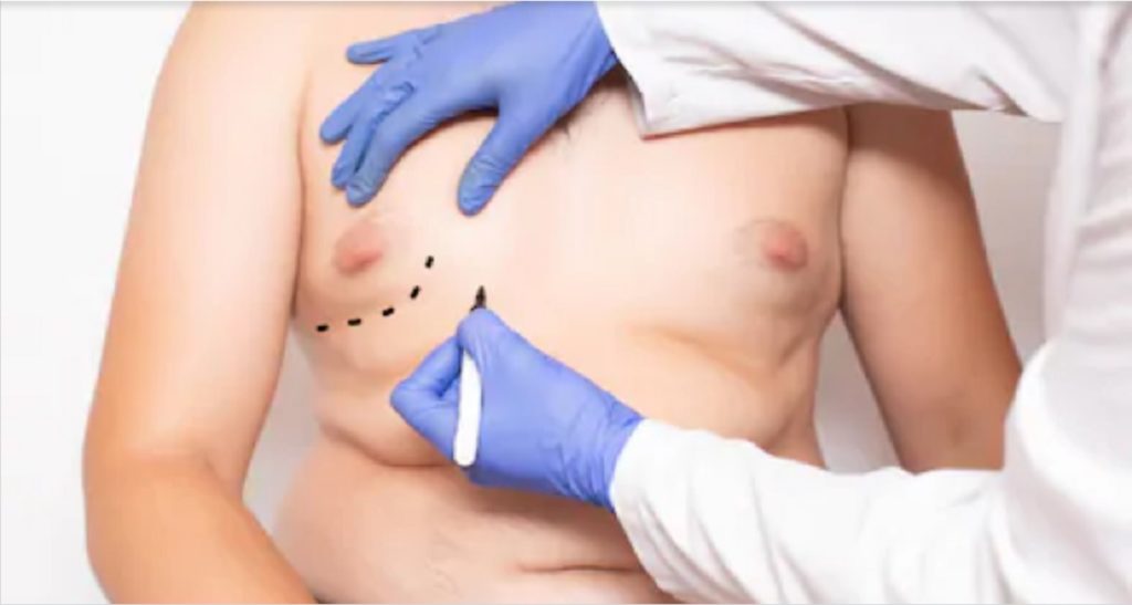 Male Breast Reduction Surgery in Delhi Male Breast Reduction Surgery in Delhi