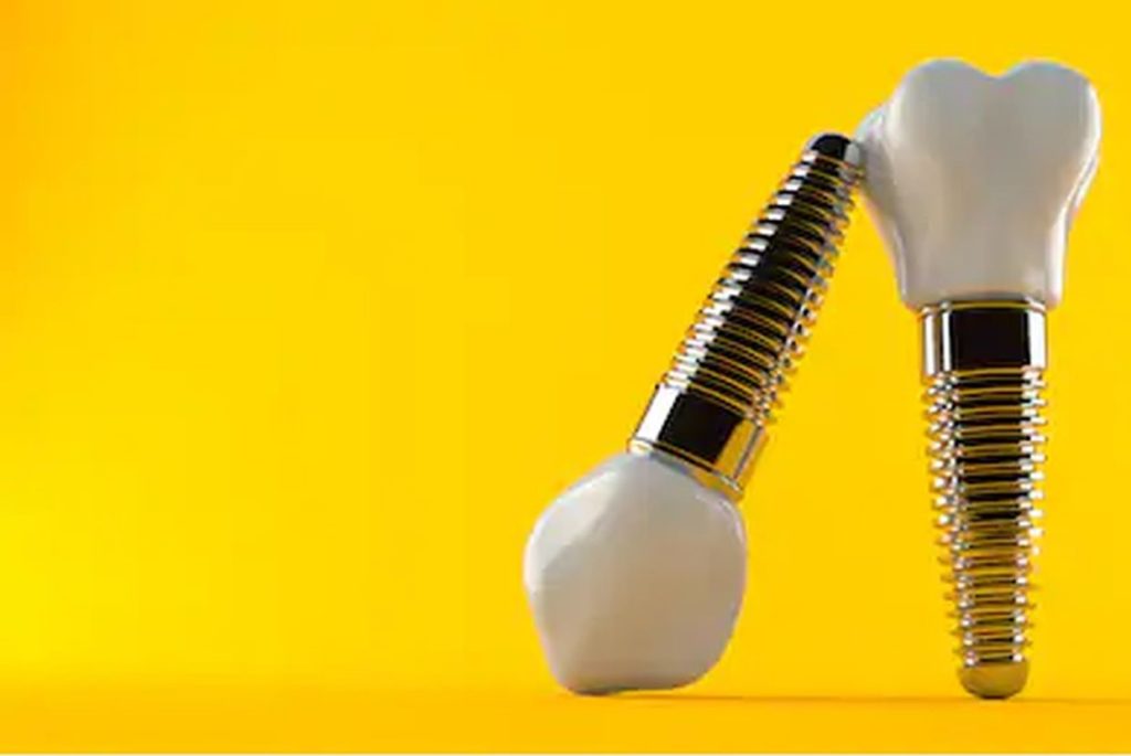Dental Implant in Delhi Dental Implant in Delhi