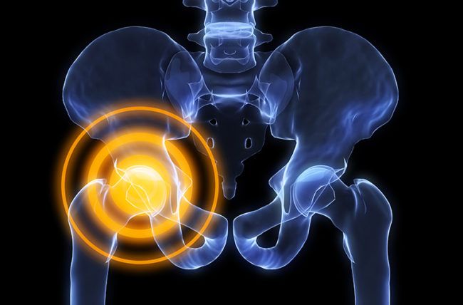 Causes of Hip Pain Causes of Hip Pain
