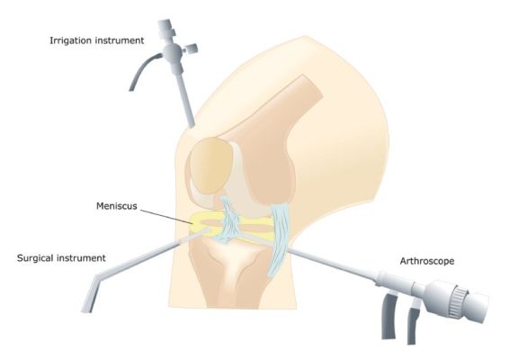 Knee Arthroscopy For Better Mobility of Your Knee Knee Arthroscopy For Better Mobility of Your Knee