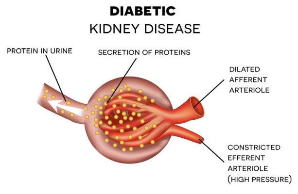 Diabetic Kidney Disease Diabetic Kidney Disease