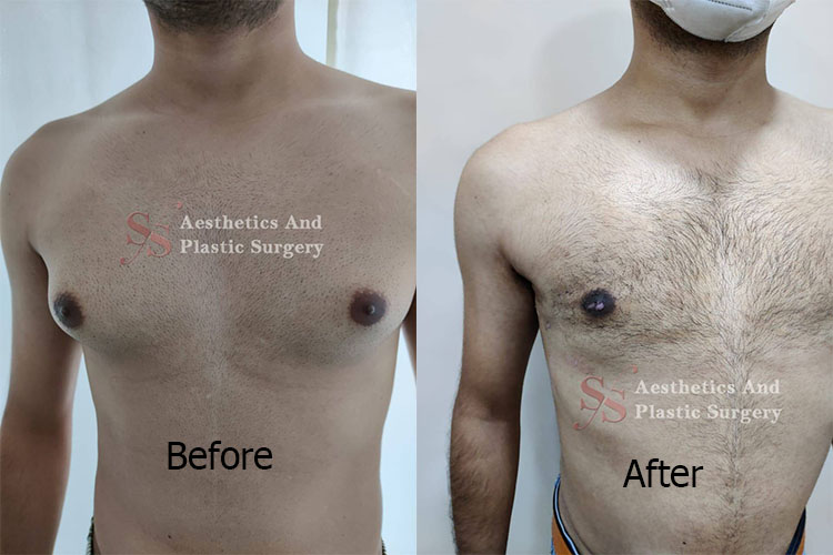 Enlarged Breast in Men – Gynecomastia Enlarged Breast in Men – Gynecomastia