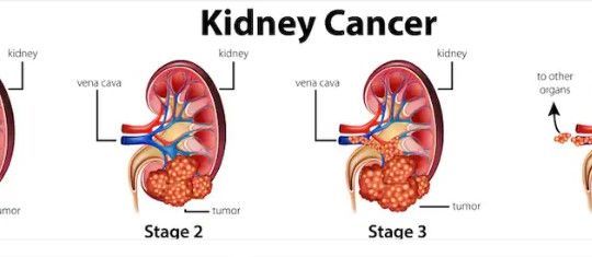 kidney cancer