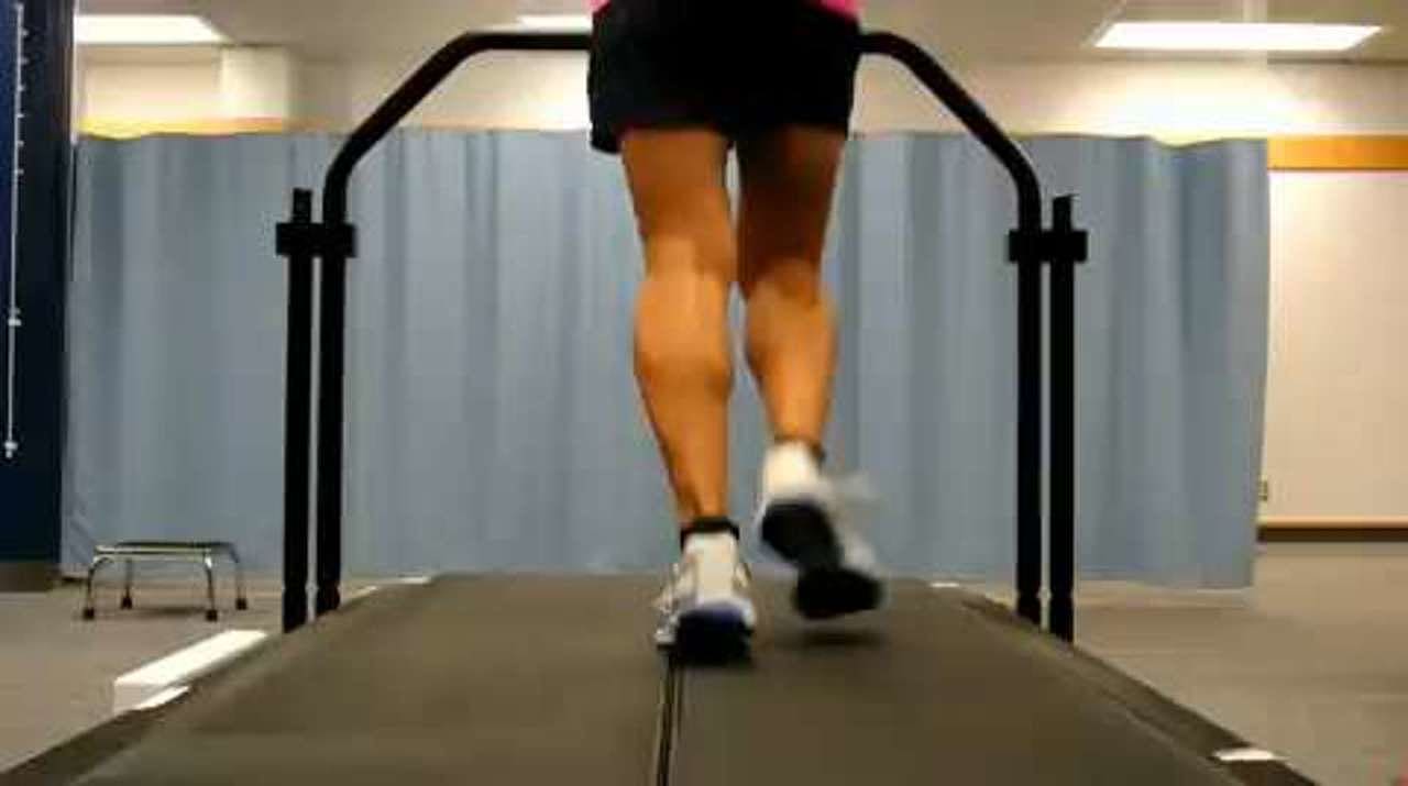 Runner with tibialis posterior tendinopathy, posterior view