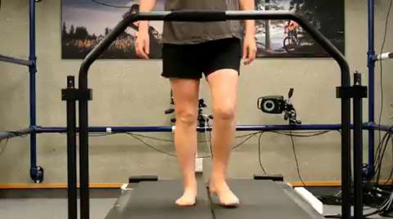 Runner with medial tibial stress syndrome walking, anterior view