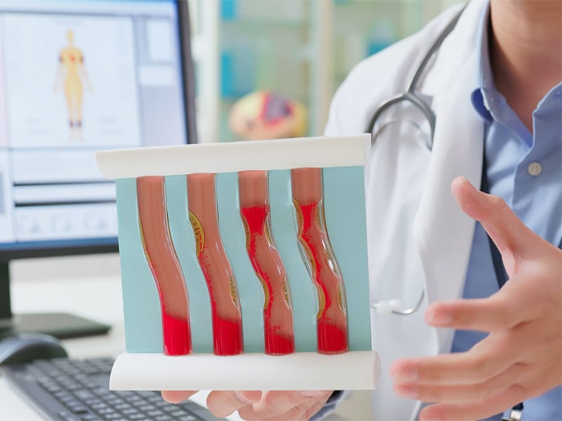 doctor showing model of plaque in arteries
