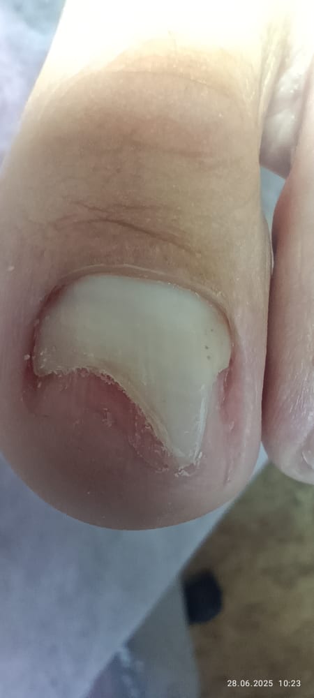 Service image for Зачистка оніхолізісу