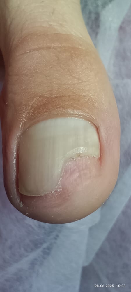 Service image for Зачистка оніхолізісу